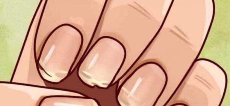 Om dina naglar ständigt spricker eller går av, kan det vara ett tecken på att din kropp vill kommunicera något viktigt om din hälsa.