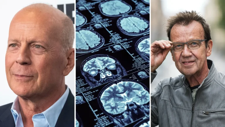 Så förändras personligheten av frontallobsdemens