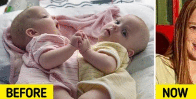 Het verhaal van de Siamese tweeling die succesvol gescheiden werd en hoe ze er nu uitzien.