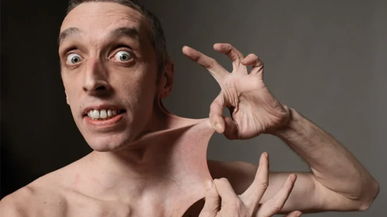 Hans hud har en alldeles egen talang! Tack vare ett ovanligt syndrom töjs den ut som ett gummiband – och nu är han en Guinness-legend!