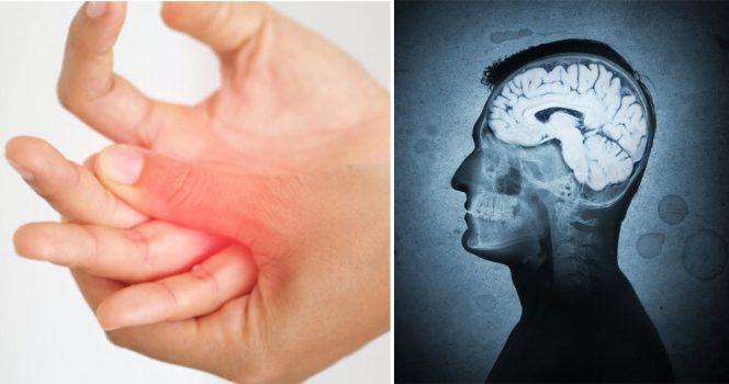 ALS: Tre tidiga symptom du inte ska ignorera